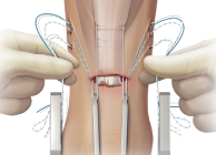 Arthrex - Achilles Tendon Rupture Surgical Treatment
